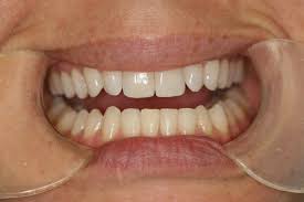 Dental Contouring