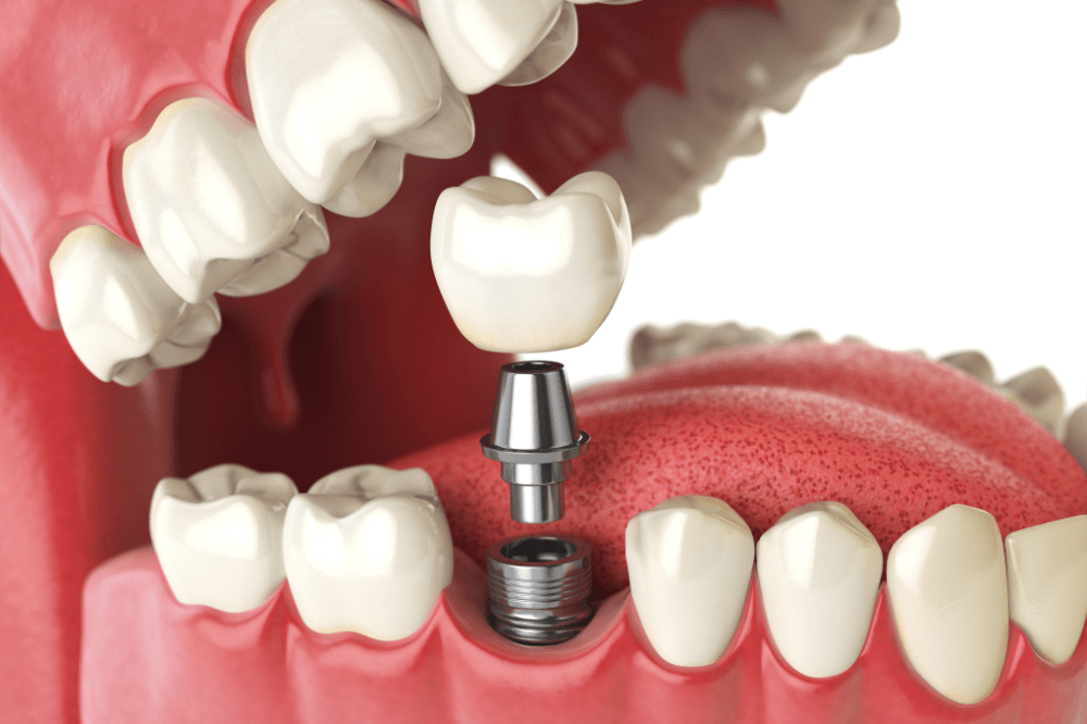 Implant Replacement