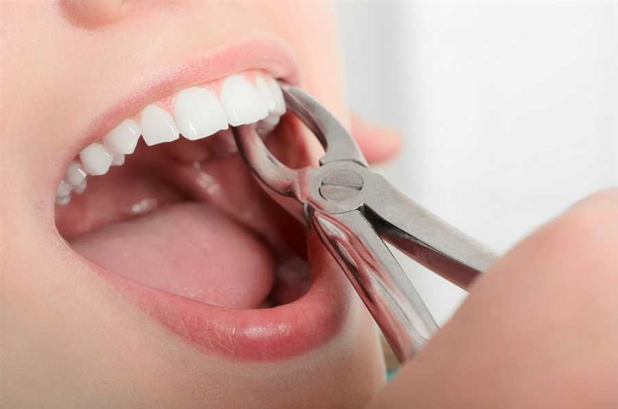 Tooth Extractions