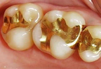 Dental Fillings