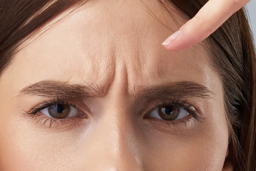 Girl pointing at her frown lines