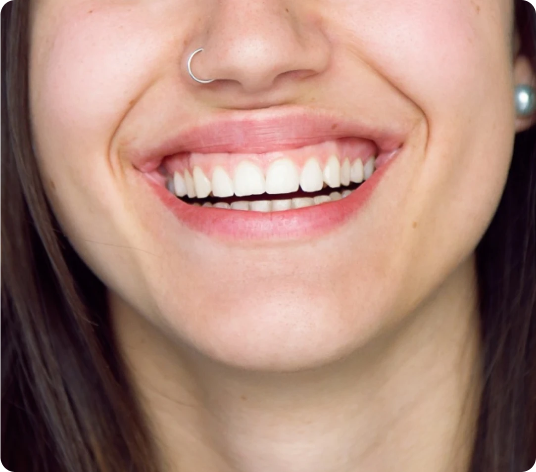 Girl smiling with gummy smile