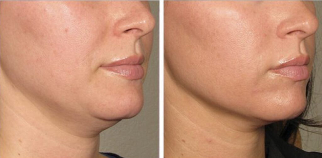 Nefertiti Neck Lift Before and After Comparison