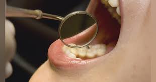 Oral Cancer Screening