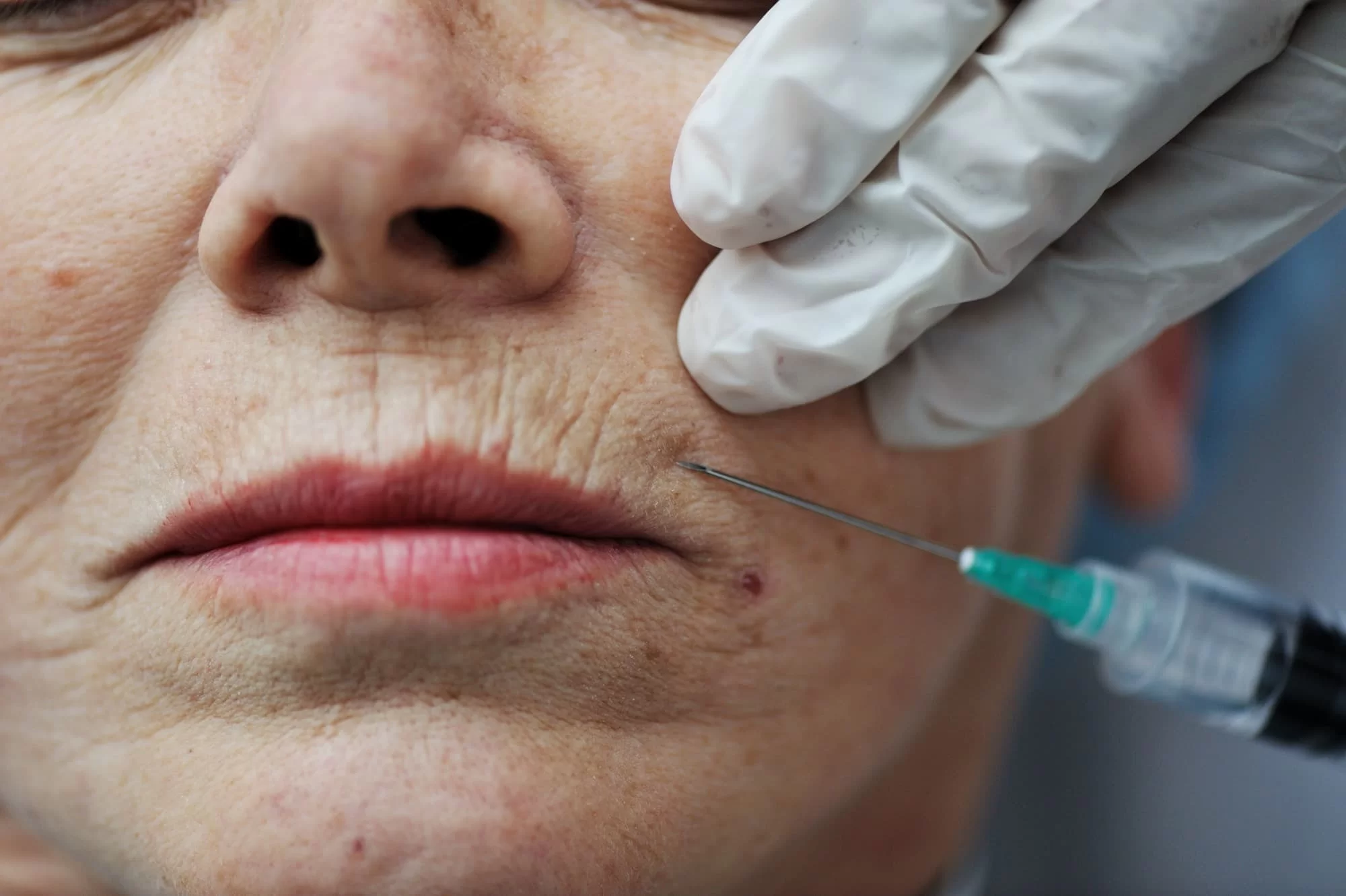 Upper Lip Lines