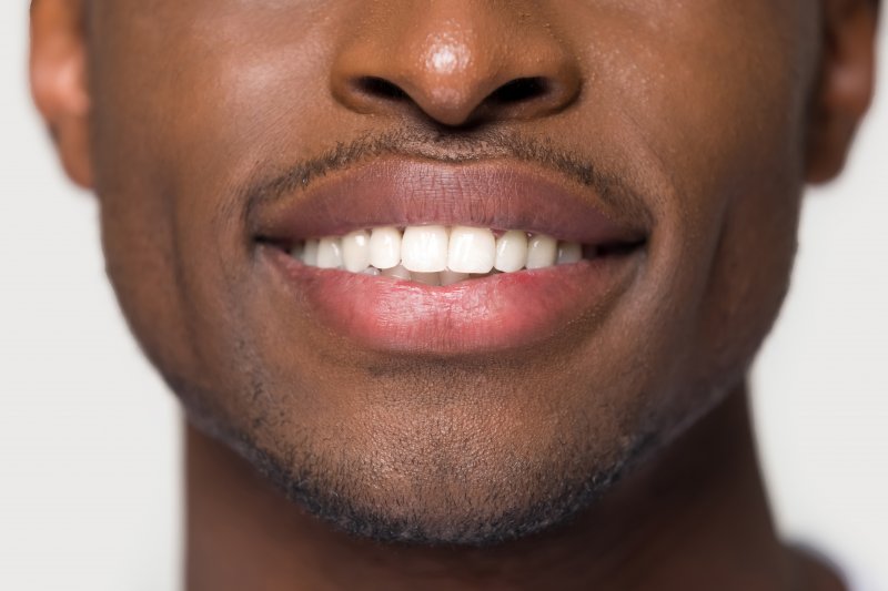 Veneers