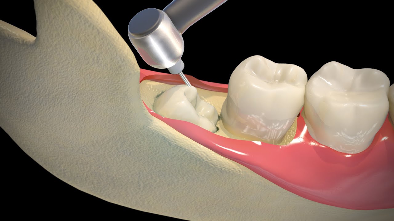 Wisdom Teeth Removal